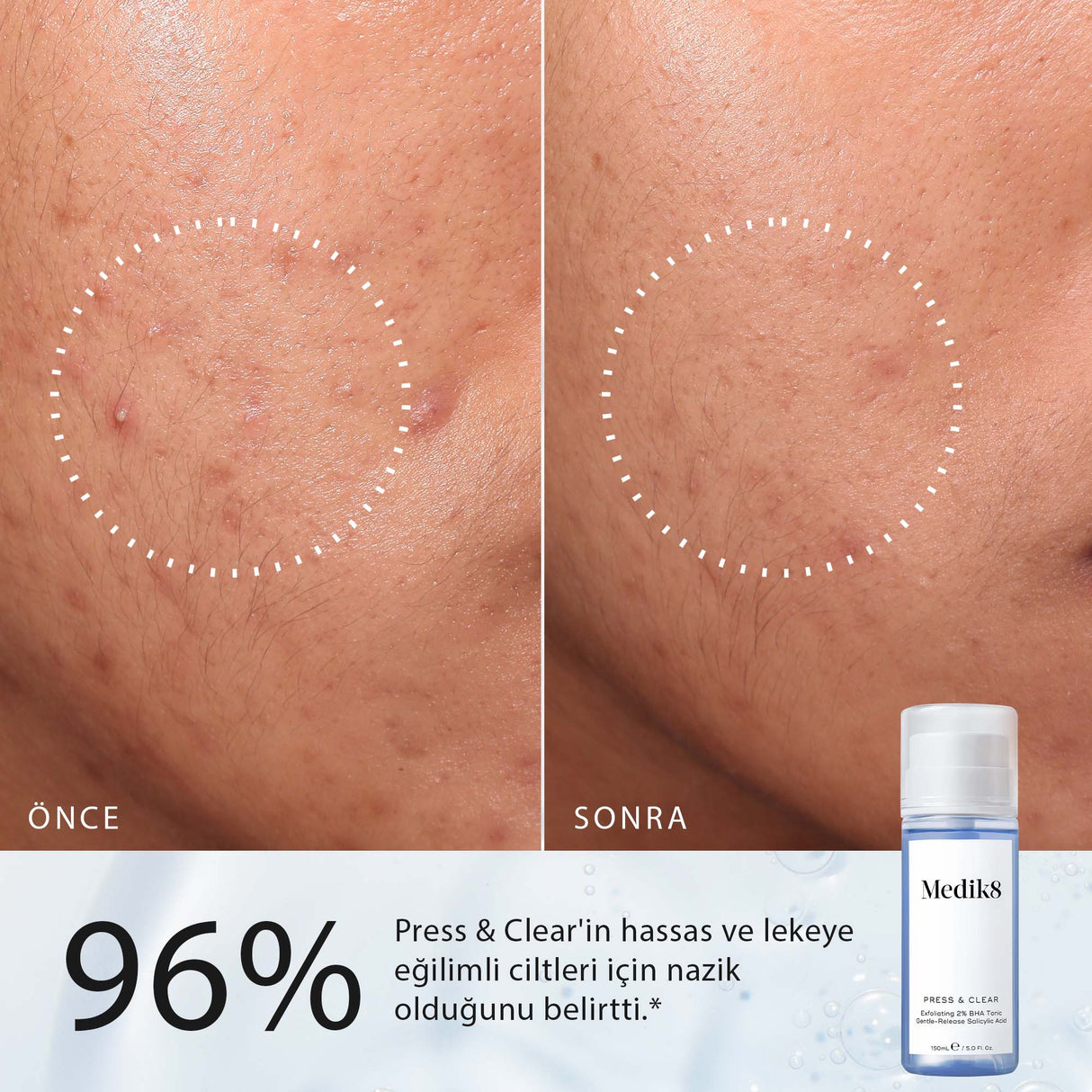 Press & Clear™ (Seyahat Boyu)